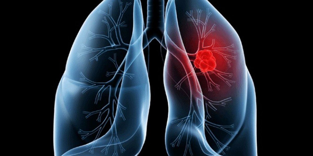 Adenocarcinoma de pulmão: o que é o câncer que atinge o papa Leão XIV